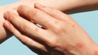 Bến Tre phát hiện ca mắc bệnh đậu mùa khỉ đầu tiên