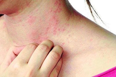  Coi chừng dị ứng kem chống nắng 