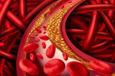  Điểm mặt thói quen xấu làm tăng mỡ máu 