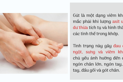 6 loại thực phẩm người bị gút cần tránh xa để hạn chế cơn đau