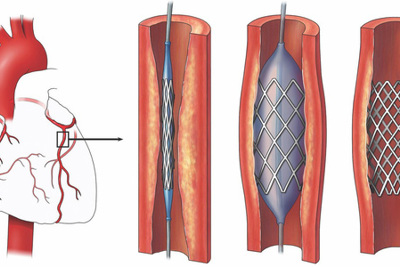 Hexacath công bố công nghệ sent thế hệ mới