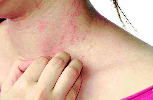 Nhìn chung dùng kem là an toàn, nhưng cũng có khi bạn bị dị ứng với một loại kem mới dùng. Nguồn: internet