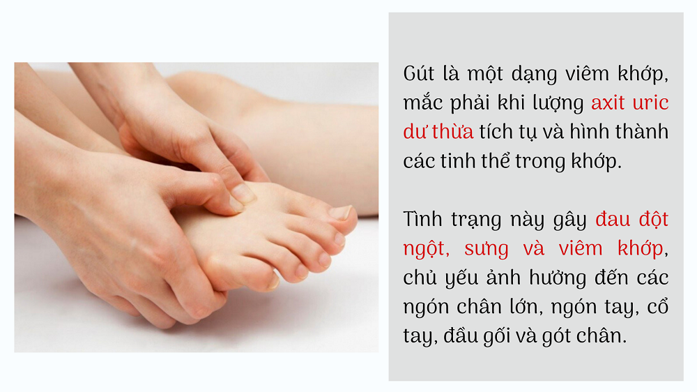 Hiện nay, không chỉ những người có tuổi mà số lượng người trẻ mắc bệnh gút (gout) ngày càng tăng. Nguồn: internet